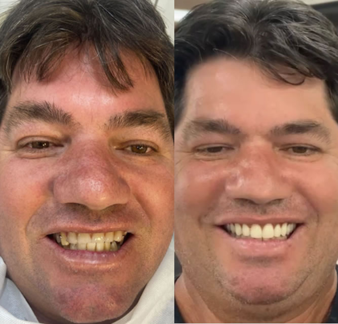 ANTES E DEPOIS.1